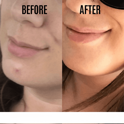 Pimpli™ - Hydrocolloid Acne Patches - Pimpli™