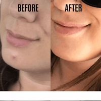 Pimpli™ - Hydrocolloid Acne Patches - Pimpli™